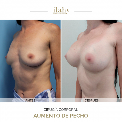 Aumento de pecho - Caso Antes y despu�s